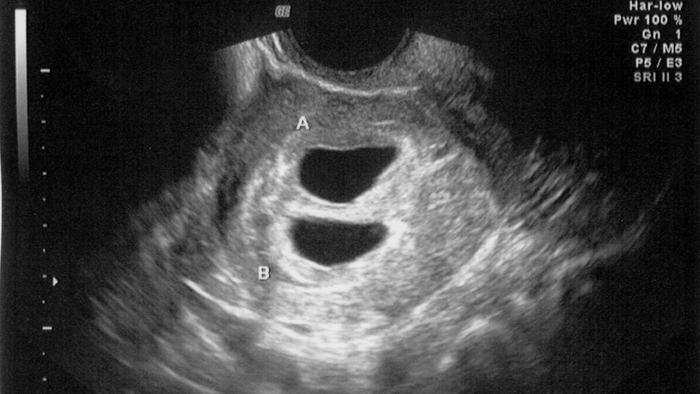 Week 4 Pregnancy Ultrasound