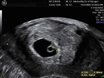 Week 6 Pregnancy Ultrasound