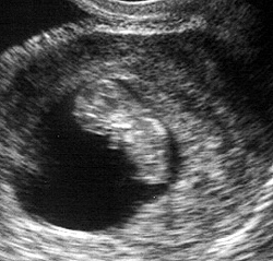 Week 7 Pregnancy Ultrasound