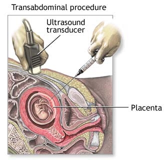 Chorionic Villus Sampling