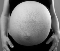 Stretch Marks During Pregnancy