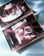 Ultrasound To See Baby’s Gender