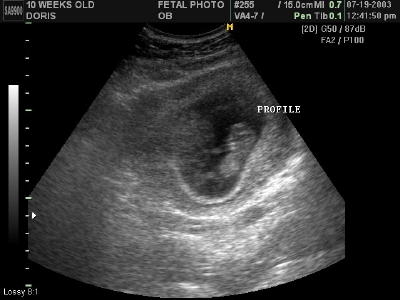 Pregnancy Development: Week 10 Ultrasound