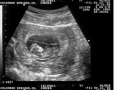 Pregnancy Development: Week 10-2 Ultrasound