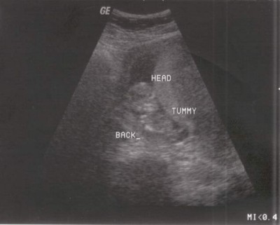 Pregnancy Development: Week 12 Ultrasound