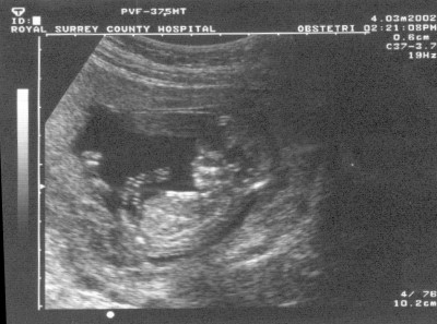 Pregnancy Development: Week 12-2 Ultrasound
