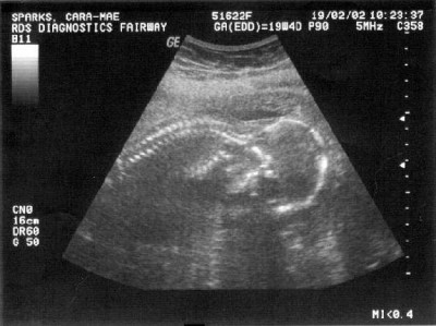 Pregnancy Development: Week 16 Ultrasound
