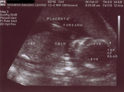 Pregnancy Development: Week 16-2 Ultrasound