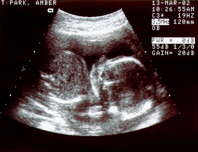 Pregnancy Development: Week 20 Ultrasound