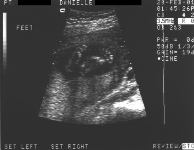 Pregnancy Development: Week 20-2 Ultrasound