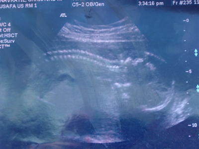 Pregnancy Development: Week 20-3 Ultrasound