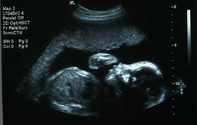 Pregnancy Development: Week 24 Ultrasound