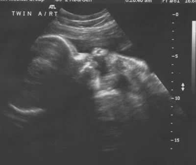 Ultrasound Week 32