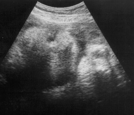 Ultrasound Week 36