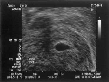 Pregnancy Development: Week 4 Ultrasound