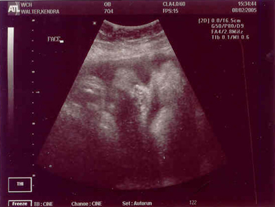 Pregnancy Development: Week 40 Ultrasounds