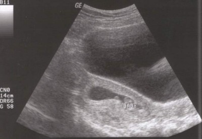 Pregnancy Development: Week 8 Ultrasound