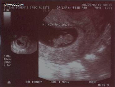 Pregnancy Development: Week 8-2 Ultrasound